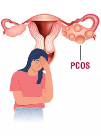 What is PCOS?