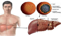 Hepatitis is an inflammation of the liver that causes liver cancer and other health problems