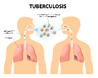 TB infection is spread through droplets from an infected person