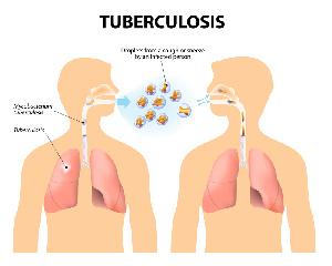 Tuberculosis Dreamstime