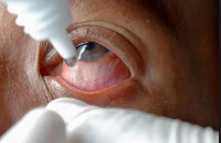 Glaucoma is a medical condition that affects the eyes