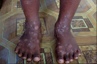 A boy with scabies on his feet