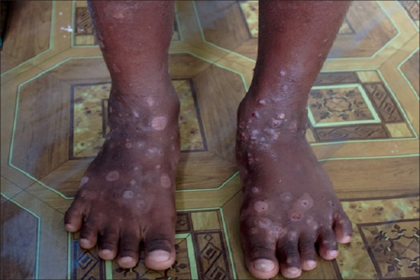 A boy with scabies on his feet