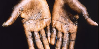 Mpox primarily spreads through direct contact, with symptoms including fever and rash