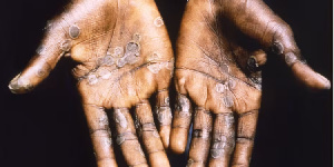 Mpox primarily spreads through direct contact, with symptoms including fever and rash