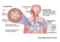 Tuberculosis is an infectious disease that usually affects the lungs