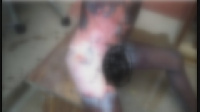 The severely burnt groin of the 11-year-old boy