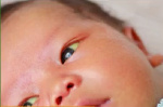 Jaundice in newborn babies on the rise