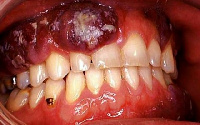 Researchers say oral cancer accounts for the deaths of 200,000 people around the world annually