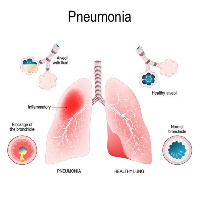 File photo of pneumonia