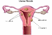 Fibroid illustration