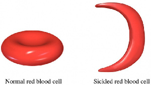 Sickle Cell