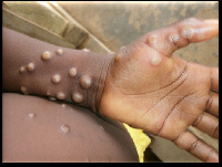 Monkeypox is a zoonotic virus