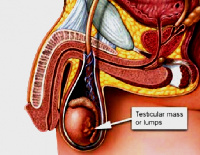 File photo: Testicular cancer