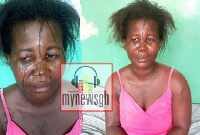 The victim bathed her colleague with acid at Akim Oda