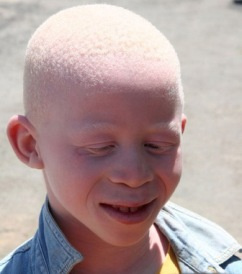 Albino Young Boy