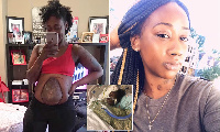 Takieyah Reaves now lives with her intestines hanging out of her abdomen