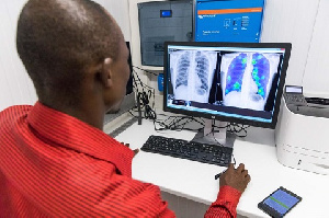 The CAD4TB software detects the presence of tuberculosis in a person