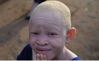 A young Albino in a pose for the camera