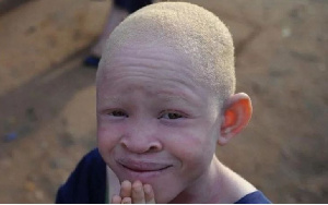 A young Albino in a pose for the camera