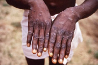 More than 16,000 cases of Monkeypox have been reported