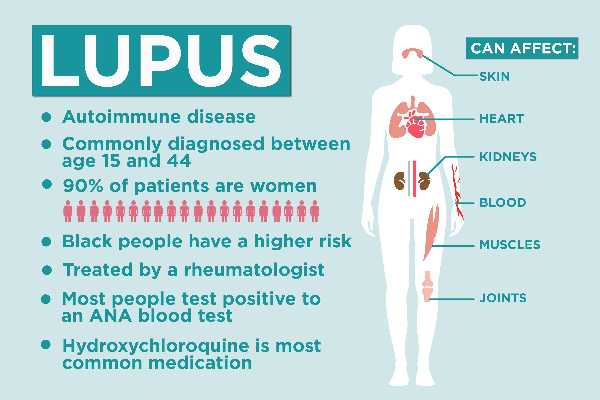 File photo/Lupus