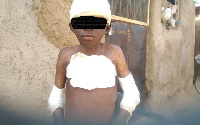 Ayinbisa is still nursing his wounds over one year after a man set him ablaze