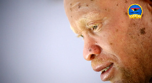 Andrew Kwame Daklo, Person with albinism