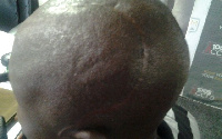 The victim Danso has several scars on his head