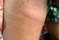 A bruised arm of one of the flogged students