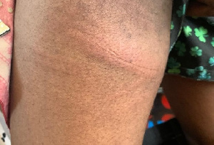 A Bruised Arm Of One Of The Flogged Students