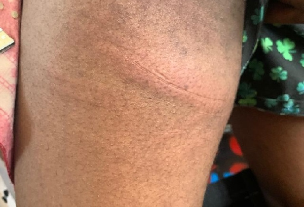 A bruised arm of one of the flogged students