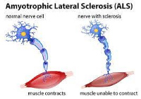 Amyotrophic Lateral Sclerosis (ALS)