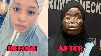 Memuna Malik before and after the accid burns