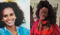 Ms Atsede suffered major acid burns to her entire face, chest, hands and one of her legs