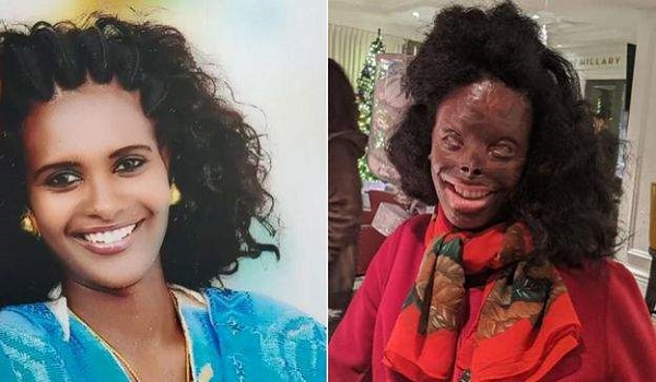 Ms Atsede suffered major acid burns to her entire face, chest, hands and one of her legs