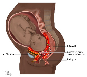 Obstetric Fistula