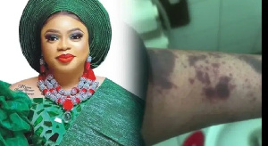 Bobrisky Allegedly Injured 