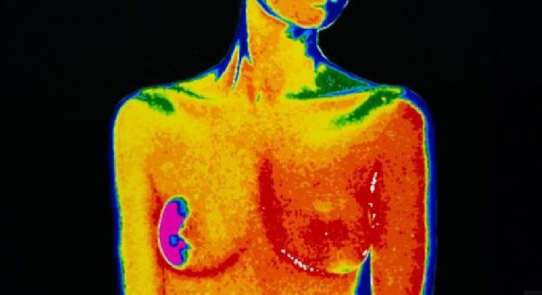 Signs of breast cancer may include a lump in the breast and a change in breast shape