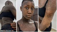 Onyinye na 28 years old model wey dey live wit lamellar ichthyosis