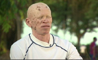 File photo of a person living with albinism