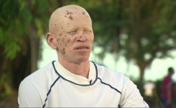 File photo of a person living with albinism