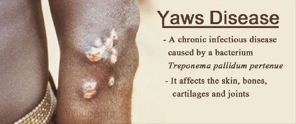 Yaws disease