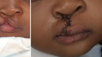 Before and after picture of baby wit cleft lip after surgery