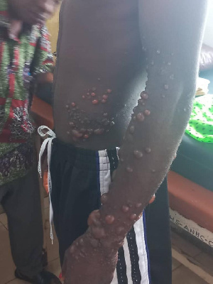 File Photo: monkey pox infection