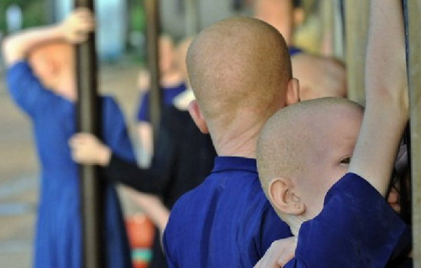 Worldwide, it is estimated that one in 20,000 people are affected by albinism