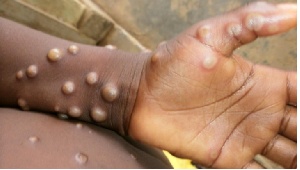 Across Africa, over 17,000 Mpox cases have been confirmed, primarily in the DRC