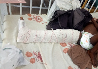 One of the children in bed with fracture on the right leg