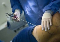 A surgeon is seen performing a liposuction procedure. File photo