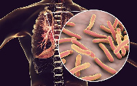 File photo of respiratory disease, tuberculosis